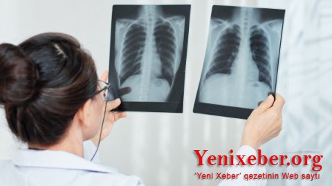 Ermənistanda koronavirusdan ölənlərin sayı   -