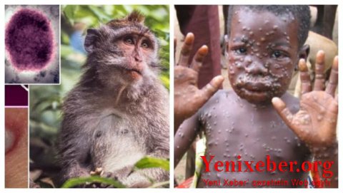 Meymunçiçəyi koronavirus qədər təhlükəli deyil - 