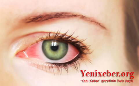 Gözlərdə sancma, sulanma, qızartı -
